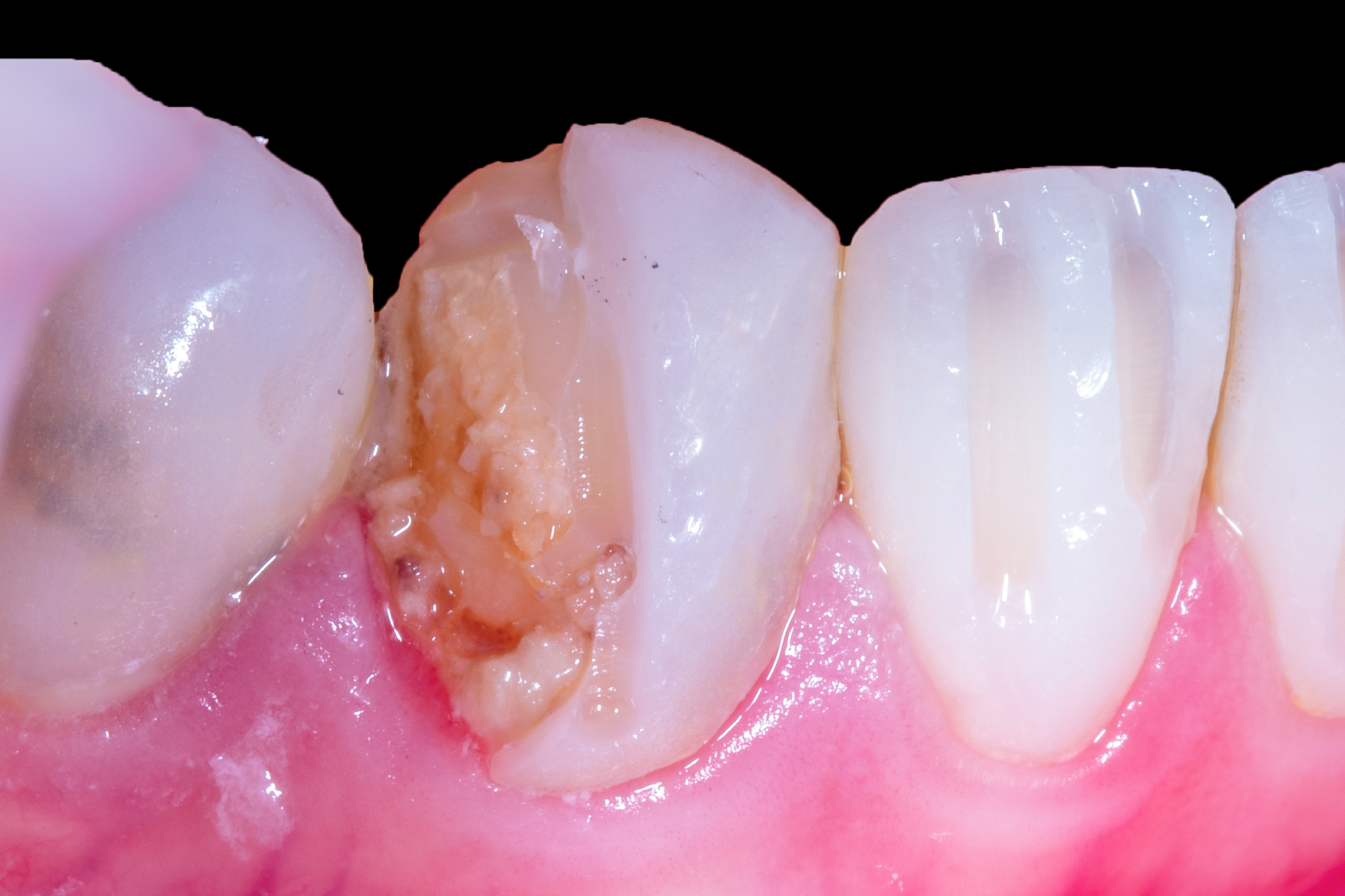 Klinisches Beispiel: Zahn nach Entfernung eines Veneers wegen Sekundärkaries